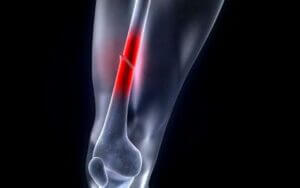 Röntgenfelvétel a combcsonttörésről, pirossal jelölve, hol a sérülés.